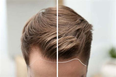 5 Veelvoorkomende Mythes Over Haartransplantatie