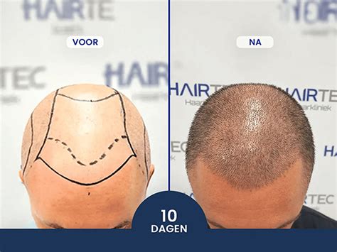 Alternatieven Voor Haartransplantatie: Wat Zijn Ze?