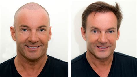 Haartransplantatie En Huidtype: Wat Is De Perfecte Match?