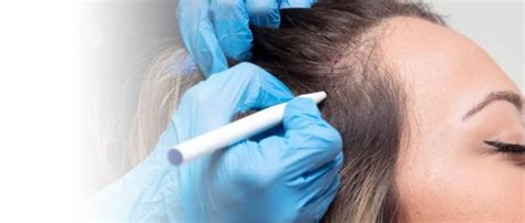 Haartransplantatie En Medische Aansprakelijkheid